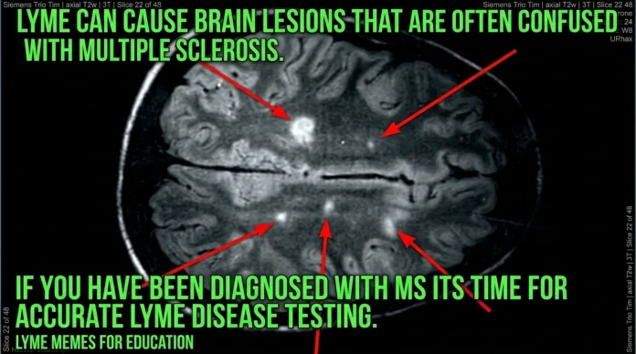 Lyme Disease or MS? Why Your Brain MRI White Spots Might Be Misdiagnosed