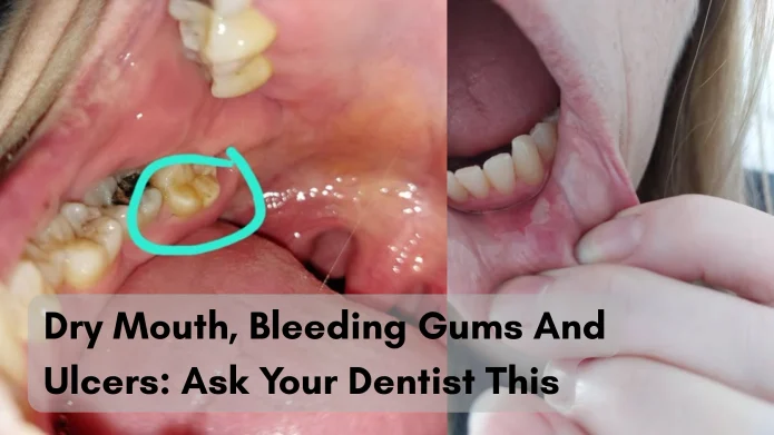 Dry Mouth, Bleeding Gums And Ulcers: Ask Your Dentist This