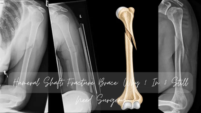 Humeral Shaft Fracture Brace: Why 1 In 3 Still Need Surgery