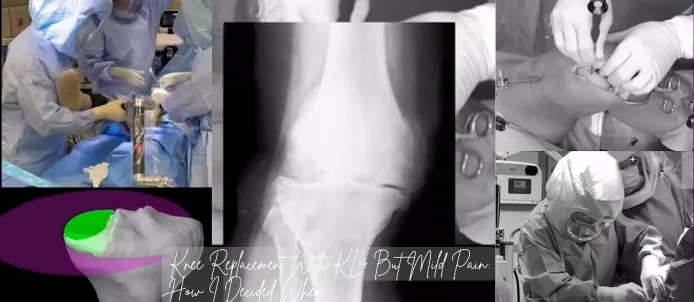 Knee Replacement With KL4 But Mild Pain: How I Decided When