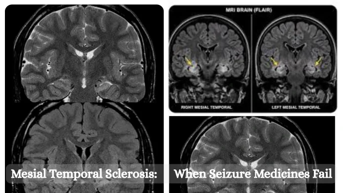 Mesial Temporal Sclerosis: When Seizure Medicines Fail