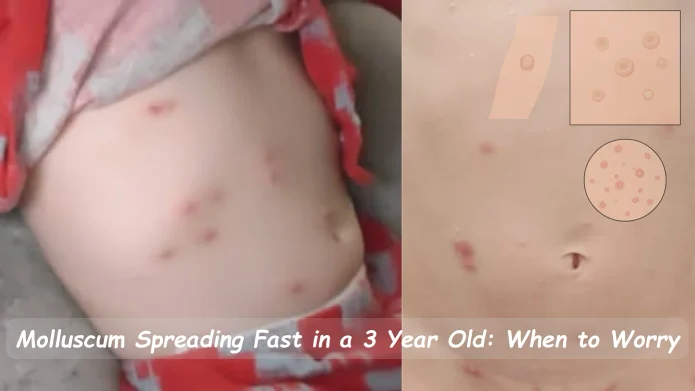 Molluscum Spreading Fast in a 3 Year Old: When to Worry