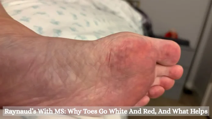 Raynaud’s With MS: Why Toes Go White And Red, And What Helps