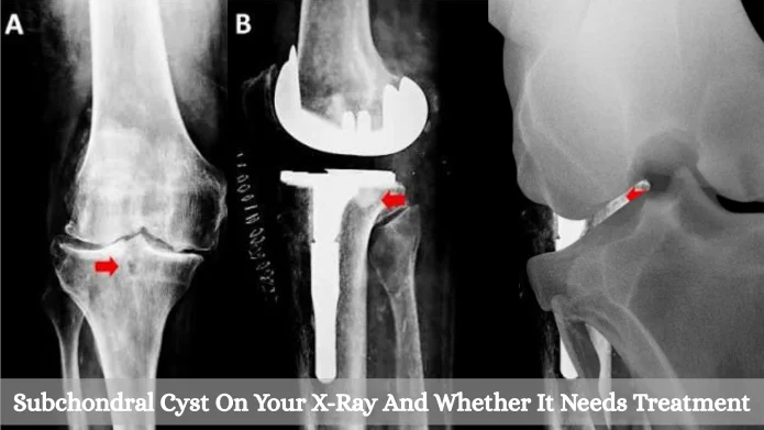 Subchondral Cyst