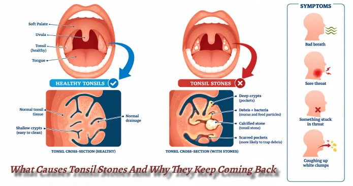 What Causes Tonsil Stones And Why They Keep Coming Back